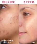 Green Tea Acne Toner - Image 5